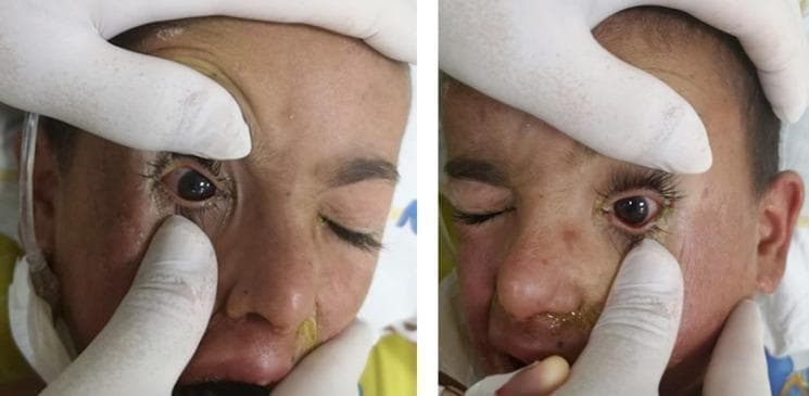 This clinical photograph displays a pediatric patient exhibiting bilateral conjunctival suffusion, a classic diagnostic sign of systemic infection such as leptospirosis. The image captures the periocular region with the eyelids being manually retracted by gloved hands to reveal marked, diffuse injection of the bulbar conjunctiva. Both eyes show prominent vascular engorgement and redness against the sclera, without evidence of purulent exudate directly on the ocular surface. Associated findings include periorbital edema and yellow-crusted discharge (serosanguinous or purulent) concentrated at the inner canthus and along the eyelid margins. The surrounding facial skin shows generalized erythema and scattered hyperpigmented macules. The clinical context suggests an acute infectious process, likely during the spirochaetemic phase of a zoonotic illness. This visual serves as a critical educational tool for identifying systemic vasculitis manifestations and differentiating conjunctival suffusion from typical bacterial conjunctivitis in a febrile, acutely ill patient.