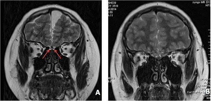 This diagnostic image displays two coronal T2-weighted brain MRI scans, labeled (A) and (B), focusing on the anterior cranial fossa of two different patients. In image A, red arrows specifically point to the olfactory region above the ethmoid bone's cribriform plate. Both images demonstrate bilateral dysplasia and hypoplasia of the olfactory bulbs, olfactory tracts, and the corresponding olfactory sulci. This anatomical area normally contains well-defined, rounded olfactory bulbs sitting within the olfactory sulci of the frontal lobes. However, in these patients, the sulci are shallow or poorly formed, and the olfactory structures are visibly diminished or absent. This radiological finding is a hallmark diagnostic feature of Kallmann syndrome, reflecting a failure in the development and migration of the olfactory nerves and gonadotropin-releasing hormone (GnRH) neurons. The images illustrate the neuroanatomical basis for clinical anosmia or hyposmia in the context of idiopathic hypogonadotropic hypogonadism.
