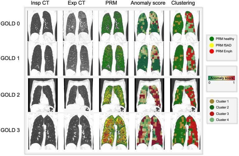 This composite diagnostic image illustrates the progression of Chronic Obstructive Pulmonary Disease (COPD) across GOLD stages 0 to 3 using multiple imaging modalities. The visual is organized into a grid: the first two columns show coronal slices of Inspiratory (Insp) and Expiratory (Exp) CT scans. Subsequent columns show color-coded overlays representing different analytical methods: Parametric Response Mapping (PRM), Anomaly Score, and Clustering.
The PRM column tracks disease manifestation: 'PRM healthy' (green) dominates GOLD 0-1, while 'PRM fSAD' (functional small-airway disease, yellow) and 'PRM Emph' (emphysema, red) increase significantly in GOLD 2 and 3. The 'Anomaly Score' column displays a self-supervised learning gradient (green 0 to red 1), showing higher scores (more red) that spatially correlate with PRM-defined diseased areas. The 'Clustering' column identifies four distinct tissue types (Cluster 1-4). This comparison demonstrates how advanced computational mapping correlates with traditional GOLD staging, highlighting the spatial distribution of emphysema and air trapping in the upper and middle lung fields as disease severity advances.