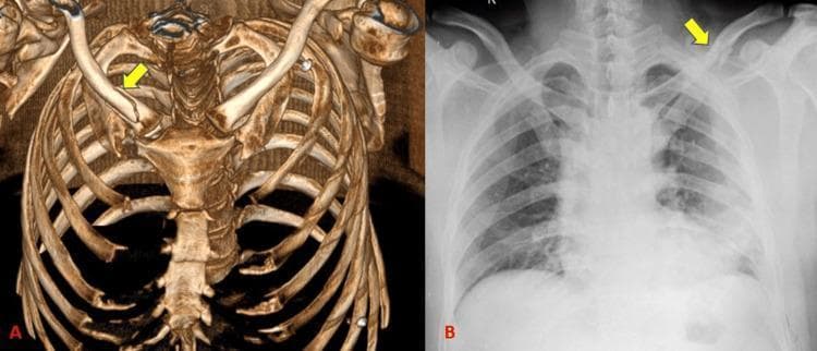 This comparison image showcases a left clavicle fracture using two different imaging modalities: (A) a 3D volume-rendered computed tomography (CT) reconstruction and (B) a standard posterior-anterior (PA) chest radiograph. Both images highlight the fracture site with yellow arrows. In the 3D CT reconstruction (A), the skeletal anatomy of the thorax, including the sternum, ribs, and clavicles, is rendered with high spatial resolution and depth. The mid-shaft clavicular fracture is clearly visualized as a complete discontinuity with inferior displacement of the distal segment. In contrast, the chest radiograph (B) displays a 2D projection where the fracture is visible but partially obscured by the superimposition of the underlying ribs and lung parenchyma. The comparison emphasizes the clinical utility of 3D CT for precisely evaluating fracture morphology, degree of misalignment, and complex spatial relationships in thoracic trauma, whereas the radiograph provides a standard screening view with lower sensitivity for subtle osseous detail.
