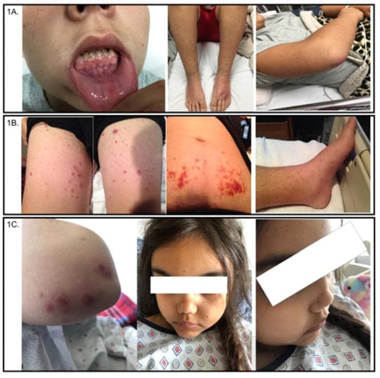 A composite of clinical photographs (labeled 1A, 1B, 1C) showcasing the dermatologic and oral manifestations of pediatric Granulomatosis with Polyangiitis (GPA). Panel 1A illustrates significant gingival hyperplasia with associated mucosal bleeding and friability, alongside diffuse purpura and pitting edema on the bilateral lower extremities and right arm. Panel 1B displays a diffuse, erythematous papular rash distributed across the bilateral thighs, lower legs, and anterior trunk. Panel 1C presents scattered, palpable purpuric lesions on the upper extremities and a characteristic saddle nose deformity involving the collapse of the nasal bridge. Collectively, these images demonstrate the multisystemic nature of ANCA-associated vasculitis in children, highlighting key clinical signs such as small-vessel vasculitic skin lesions, characteristic midface skeletal changes, and upper respiratory tract involvement. The visual evidence supports medical education on the physical examination findings essential for diagnosing systemic autoimmune diseases and pauci-immune crescentic glomerulonephritis.