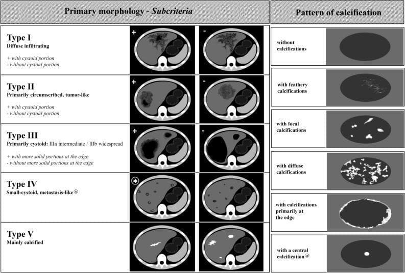 This educational infographic details the Echinococcus multilocularis Ulm Classification for Computed Tomography (EMUC-CT), a standardized system for evaluating hepatic Alveolar Echinococcosis (AE). The diagram is divided into two sections: Primary Morphology and Patterns of Calcification.
The left section illustrates five morphological types (I-V) using axial CT cross-sections of the liver. Type I (diffuse infiltrating) and Type II (primarily circumscribed, tumor-like) are sub-categorized by the presence or absence of a cystoid portion. Type III (primarily cystoid) distinguishes between intermediate and widespread involvement, further categorized by solid peripheral portions. Type IV displays small-cystoid, metastasis-like lesions, while Type V represents mainly calcified, inactive lesions.
The right panel illustrates six distinct calcification patterns within hepatic lesions: feathery (branching), focal (isolated spots), diffuse (widespread), edge-weighted (peripheral), and central. The classification system is designed to improve diagnostic accuracy and clinical assessment of disease activity in patients with Alveolar Echinococcosis.