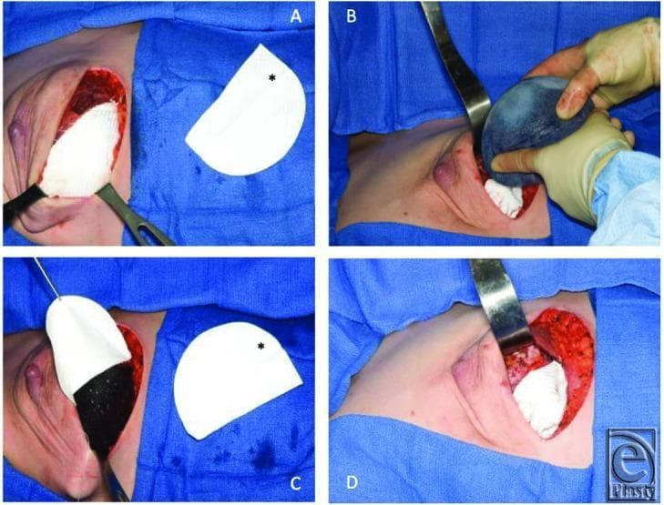 A series of four intraoperative clinical photographs (Panels A-D) illustrating the surgical technique for breast reconstruction using a Gore-Tex DualMesh sling and a tissue expander. Panel A shows a dissected subpectoral pocket with a white, semi-circular synthetic mesh template (marked with an asterisk) indicating the planned positioning along the inframammary fold. Panel B demonstrates the insertion of a textured tissue expander into the surgical pocket while the mesh is visible in the background. Panel C depicts the expander seated in the subpectoral position with the flexible white mesh retracted to show the pocket depth. Panel D shows the final inset where the mesh is integrated as a lower-pole sling, secured to the surrounding pectoralis major muscle and inframammary fold to support the inferior pole of the expander. The procedure utilizes surgical retractors and standard sterile technique to create a dual-plane pocket for eventual implant-based reconstruction.