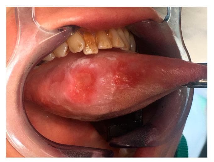 This clinical photograph displays a preoperative view of a large lesion on the right lateral border of the mobile tongue, identified as squamous cell carcinoma (SCC). The lesion is characterized by an exophytic, ulcerated appearance with mixed erythematous (red) and leukoplakic (white) components. Its borders are irregular and poorly defined, showing signs of infiltration into the surrounding lingual mucosa. The oral cavity is accessed using a clear plastic cheek retractor, and a metal surgical instrument is positioned at the tongue tip to facilitate lateral displacement for better visualization. Adjacent anatomical structures include the maxillary teeth, which exhibit extrinsic staining. This image serves as a teaching example of high-stage oral malignancy (T3), demonstrating classic morphological features of lingual SCC such as surface heterogeneity, ulceration, and loss of normal tissue architecture. It is relevant for oncology, oral surgery, and pathology education regarding head and neck cancer presentation.
