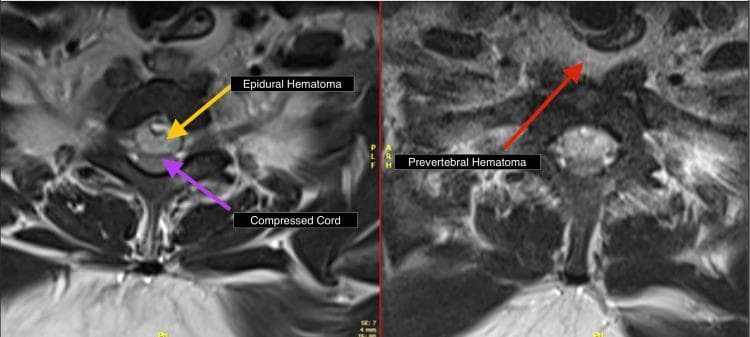 This diagnostic image consists of two side-by-side axial T2-weighted MRI (T2WI) views of the cervical-thoracic spine. The left panel demonstrates a large intraspinal epidural hematoma, visualized as an area of heterogeneous hyperintensity within the spinal canal. A yellow arrow points to the hematoma, while a purple arrow indicates the resulting anterior compression of the spinal cord, which appears flattened and displaced. The right panel highlights the prevertebral region, where a red arrow identifies a prevertebral hematoma manifesting as hyperintense fluid collection anterior to the vertebral body. These findings illustrate significant soft tissue trauma, specifically secondary to whiplash or spinal injury, leading to cord compromise. The image serves as an educational tool for identifying acute post-traumatic spinal hematomas and assessing their spatial relationship with the spinal cord and vertebral column.