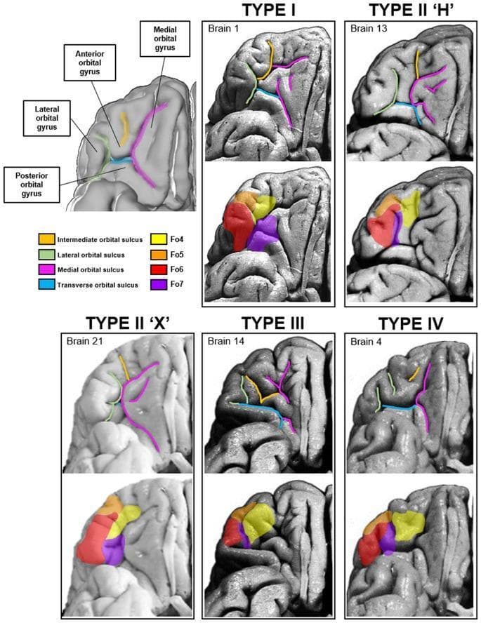 This anatomical diagram and series of diagnostic-style renders illustrate the variability of sulcal and gyral patterns in the human right orbitofrontal cortex (OFC). The image classifies five distinct pattern types: TYPE I, TYPE II 'H', TYPE II 'X', TYPE III, and TYPE IV. Each panel includes a superior view highlighting major sulci: the medial orbital sulcus (magenta), lateral orbital sulcus (green), transverse orbital sulcus (cyan), and intermediate orbital sulcus (yellow).
Below each sulcal pattern, corresponding cytoarchitectonic maps delineate four distinct cortical areas: Fo4 (yellow), Fo5 (orange), Fo6 (red), and Fo7 (purple). TYPE I shows a segmented medial sulcus, while TYPE II 'H' and 'X' demonstrate variations where the transverse sulcus forms a bridge or intersection. TYPE III displays a prominent transverse sulcus dividing the posterior region, and TYPE IV features a continuous medial sulcus with a fragmented lateral sulcus. This resource demonstrates inter-individual neuroanatomical variability in the lateral OFC, which is critical for understanding functional localization and surgical planning in the ventral prefrontal cortex.