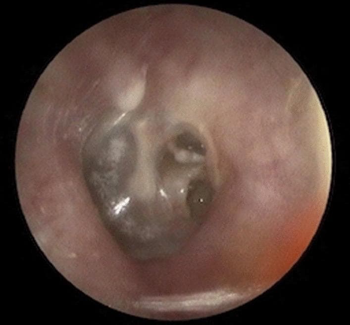 A clinical otoscopic photograph of the left ear demonstrating a Grade III retractive pocket (RP) with severe tympanic membrane compromise. The image shows a deep retraction of the pars tensa, where the tympanic membrane is collapsed medially towards the middle ear space. The fundus of the retraction is not clearly visible, classified as a 'not-visible fundus,' which is a high-risk indicator for underlying cholesteatoma. There is evidence of ossicular chain erosion, particularly involving the long process of the incus or the incudostapedial joint, which are obscured by the retraction and associated inflammatory changes. The surrounding external auditory canal appears unremarkable, but the normal landmarks of the tympanic membrane, such as the malleus handle and the cone of light, are distorted or absent due to the chronic middle ear disease. This clinical image is significant for otolaryngology education regarding the staging of retraction pockets and the assessment of chronic otitis media with potential surgical implications for ossiculoplasty.