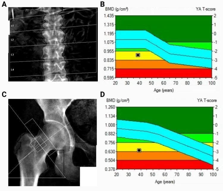 A multi-panel figure illustrating a Dual-Energy X-ray Absorptiometry (DEXA) scan. Panel A displays a clinical X-ray of the lumbar spine (L1-L4) with segmented ROI (Region of Interest) boxes and vertebral outlines. Panel C shows an X-ray of the proximal femur, including the femoral neck and total hip, with standardized geometric boxes positioned for density measurement. Panels B and D provide the corresponding densitometry plots for the spine and hip, respectively. The graphs plot Bone Mineral Density (BMD in g/cm²) on the left y-axis against age in years on the x-axis, with Young Adult (YA) T-scores on the right y-axis. The plots feature a color-coded reference range: green (normal, T-score > -1), yellow (osteopenia, T-score -1 to -2.5), and red (osteoporosis, T-score < -2.5). In both graphs, a black square marker indicates the patient's data point, situated within the yellow/orange transition zone, signifying low bone mineral density and clinically significant osteopenia.