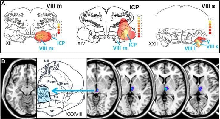 This composite educational image illustrates brainstem lesion locations associated with acute vestibular syndromes. Panel A displays three axial anatomical diagrams of the medulla and pons (levels XII, XIV, XXII) with superimposed heat-map overlays representing infarct overlap in 23 patients with rotational vertigo. The heat maps highlight concentrated involvement in the medial vestibular nucleus (VIII m), superior and lateral vestibular nuclei (VIII s, VIII l), inferior cerebellar peduncle (ICP), and the y-group. A color scale indicates the frequency of lesion overlap. Panel B correlates clinical MRI data with midbrain anatomy (level XXXVIII). It features axial T1-weighted MRI slices showing localized rostral mesencephalic-diencephalic infarcts (highlighted in blue/purple) alongside a detailed anatomical diagram identifying the interstitial nucleus of Cajal (iC), Edinger-Westphal nucleus (EW), and nucleus oculomotorius principalis (IIIpr). The figure demonstrates the anatomical substrate for central vestibular pseudoneuritis, contrasting lower brainstem lesions causing rotational vertigo with rostral midbrain lesions causing stance and gait instability.