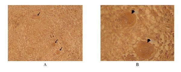 This diagnostic image consists of two light microscopy panels (A and B) showing immunohistochemical (immunoperoxidase) staining of human lung tissue from a tuberculosis (TB) patient. Panel A, at 160x magnification, displays the architectural context of a pulmonary granuloma, characterized by a central necrotic core and surrounding inflammatory cells. Arrows highlight sparsely distributed, circular regions of positive (brown) staining. Panel B provides a higher magnification (240x) view of the same tissue, revealing the detailed morphology of these positive staining areas. These are identified as multinucleated Langhans giant cells, exhibiting horseshoe-shaped arrangements of nuclei and concentrated immunoperoxidase signal within the cytoplasm. The staining utilizes a phage-displayed single-chain T-cell receptor (scTCR) specific for the Ac2SGL:CD1b complex, a lipid antigen presentation marker relevant to Mycobacterium tuberculosis infection. This image demonstrates the localization of specific lipid-antigen-presenting cells within the granulomatous microenvironment of human TB, emphasizing the clinical significance of CD1b-restricted immune responses.