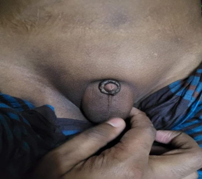 This clinical photograph displays the external genitalia of a pediatric patient, demonstrating a micropenis. The primary finding is a significantly small penis, estimated at 1.5 cm in stretched length, positioned above a normally structured but small scrotum. The skin of the penile shaft and scrotum exhibits darker pigmentation compared to the adjacent abdominal and thigh skin. Notable landmarks include the median raphe on the scrotum and a complete absence of pubic hair, consistent with Tanner stage 1 development. The patient exhibits an increased body mass index (BMI), with visible adipose tissue in the suprapubic area, which can occasionally exacerbate the appearance of a buried or small penis. The clinical context suggests secondary hypogonadism and renal parenchymal disease as part of a multisystemic condition, likely Bardet-Biedl syndrome, which often presents with obesity, polydactyly, and hypogonadotropic hypogonadism. The image is focused on the urogenital region, with the genitalia partially stabilized by a gloved hand for clinical documentation.