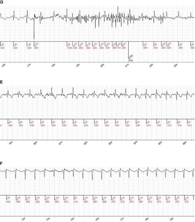 This diagnostic image displays three electrocardiogram (ECG) strips, labeled D, E, and F, recorded from an Insertable Cardiac Monitor (ICM). The visuals represent real-world clinical data used to evaluate arrhythmia detection algorithms. Panel D illustrates a transition from a baseline rhythm with identifiable QRS complexes and T waves into a high-frequency, high-amplitude chaotic segment that mimics ventricular tachycardia (VT) but is adjudicated as normal rhythm with baseline noise/artifact. Panel E shows a regular rhythm with consistent intervals and visible P waves, representing an episode misclassified by automated systems as VT but adjudicated as Atrial Tachycardia/Atrial Fibrillation (AT/AF). Panel F presents a uniform, lower-amplitude waveform with regular intervals, demonstrating how subtle rhythm variations are categorized by different diagnostic criteria. Each strip includes technical annotations below the waveform indicating interval measurements in milliseconds and event markers (e.g., VS, FS, TS, VTD) used by the monitor's classification logic. The primary educational focus is the differentiation between true cardiac arrhythmias and signal noise or baseline artifact in ambulatory monitoring devices.