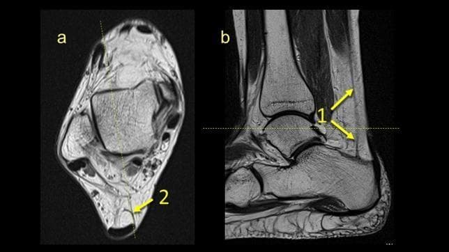 This diagnostic image consists of two MRI panels (a and b) illustrating the anatomy of the plantaris tendon and its relationship to the paratenon at the level of the ankle. Panel (a) is an axial T1-weighted image showing a transverse view of the ankle, where arrow 2 highlights the plantaris tendon inserting into the medial part of the paratenon, located superficially and posterior to the talus. Panel (b) is a sagittal cross-section where arrow 1 points to the plantaris tendon as it courses along the posterior aspect of the lower leg. The arrows in (b) demonstrate the longitudinal extension of the tendon; as it moves superiorly, the structure appears to fan out or thicken. The images provide anatomical detail regarding the distal lower leg, specifically the Kager's fat pad region and the fibrotic connections between the plantaris tendon, Achilles tendon paratenon, and local ligamentous structures. This comparison is used to visualize the plantaris tendon's morphology and its integration into the surrounding soft tissue layers for clinical and educational assessment of ankle anatomy.