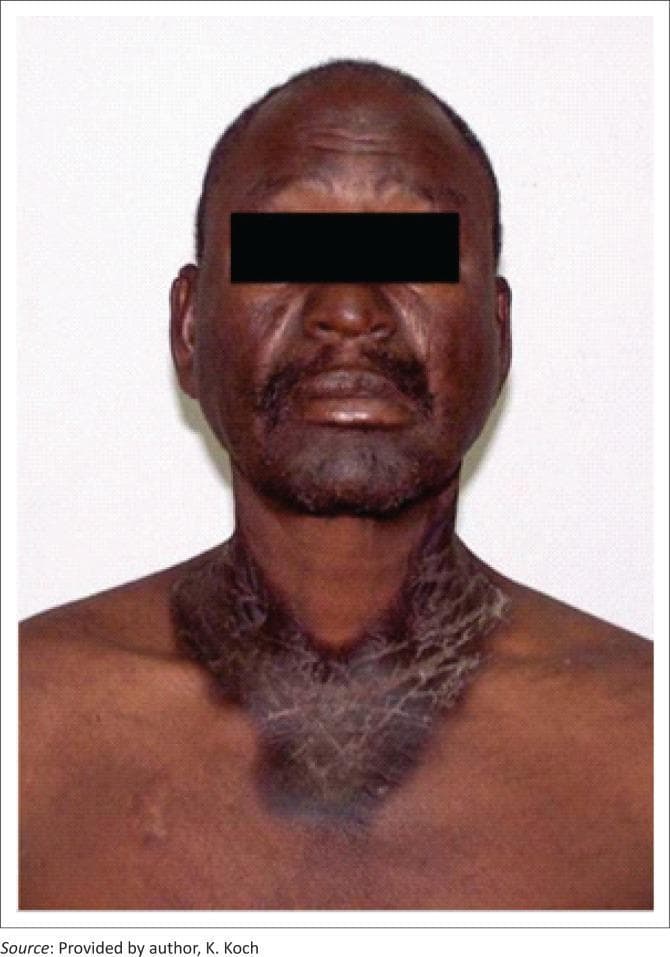 A clinical photograph of an adult male exhibiting classic dermatological manifestations of pellagra, caused by niacin (vitamin B3) deficiency. The image shows a well-defined, hyperpigmented, and xerotic (dry) skin rash with a characteristic photodistributed pattern. On the neck and upper anterior chest, the lesion forms a prominent circumferential band that transitions into a V-shaped distribution, clinically known as Casal's necklace. The affected skin appears thickened with visible scaling, fissuring, and a 'crazy-pavement' texture. Similar hyperpigmentation and skin changes are visible across the face, particularly on the forehead and perioral regions. These findings represent the 'dermatitis' component of the classic triad of pellagra (dermatitis, diarrhea, and dementia) and are frequently associated with advanced HIV or certain medications like isoniazid that interfere with niacin metabolism. This visual material is used in dermatology and nutrition education to demonstrate systemic nutritional deficiencies and photosensitive eruptions.