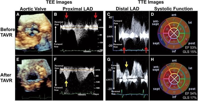 A comparison panel of diagnostic images illustrating hemodynamic and structural changes before and after Transcatheter Aortic Valve Replacement (TAVR) for severe aortic stenosis. The top row (Before TAVR) includes: (A) a 3D transesophageal echocardiogram (TEE) showing restricted aortic cusp motion; (B-C) pulse-wave Doppler scans of the proximal and distal left anterior descending (LAD) coronary artery demonstrating systolic flow reversal (indicated by red arrows); and (D) a transthoracic echocardiography (TTE) bull's-eye plot of global longitudinal strain (GLS 15%) and ejection fraction (EF 53%). The bottom row (After TAVR) shows: (E) relief of stenosis following implantation of a self-expandable valve; (F-G) Doppler scans showing the conversion of systolic LAD flow from reversal to forward flow (indicated by yellow arrows); and (H) post-procedural improvement in myocardial mechanics with GLS increased to 17%. The composite demonstrates the resolution of coronary flow abnormalities and improvement in left ventricular strain following successful TAVR.