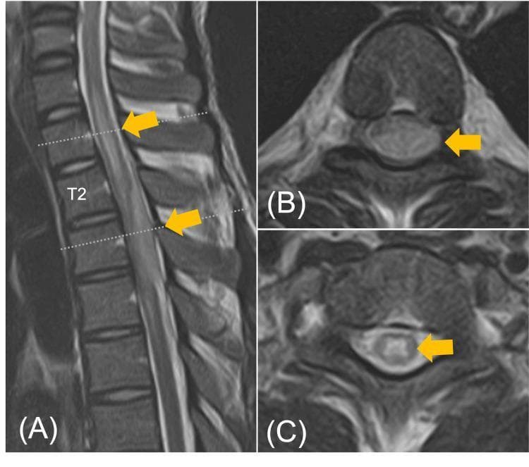 This diagnostic imaging panel displays T2-weighted magnetic resonance imaging (MRI) scans of the thoracic spine, highlighting a significant intradural extramedullary lesion. (A) Sagittal view: A hyperintense, spindle-shaped lesion is visible in the posterior aspect of the spinal canal, spanning the T2 to T4 vertebral levels. The mass causes notable ventral displacement and compression of the spinal cord. (B) Axial view at the T3 level: The lesion (indicated by a yellow arrow) occupies the dorsal aspect of the intradural space, resulting in severe compression and flattening of the cord. (C) Axial view at the T1 level: Increased intramedullary signal intensity is observed within the spinal cord, suggestive of perilesional edema or compressive myelopathy. The images demonstrate the visual findings of a thoracic spinal tuberculoma, emphasizing the mass effect on neural structures and secondary cord changes. Educational focus includes localizing intradural extramedullary pathologies and recognizing radiological signs of spinal cord compression.
