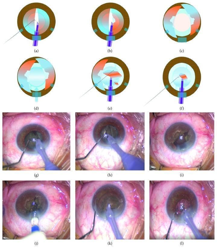 A multi-panel series of anatomical diagrams (a-f) and corresponding intraoperative clinical photographs (g-l) illustrating the 'crack, reduce, and implant' phacoemulsification technique for cataract surgery. The sequence demonstrates the mechanical management of a dense lens nucleus within the anterior segment of the eye. Panels a and g show the initial vertical groove formation and cracking of the nucleus into two halves. Panels b and h depict the 'shaving' or hollowing out of the core of each nuclear half to reduce mass while maintaining the capsular bag integrity. Panels c and i illustrate the prolapse of these nuclear halves toward the iris plane assisted by ophthalmic viscosurgical devices (OVD). Panels d and j show the early implantation of a foldable intraocular lens (IOL) into the capsular bag while nuclear fragments are still present, serving to protect the posterior capsule. The final panels (e, f, k, l) demonstrate the subsequent chopping of the remaining nuclear material into small fragments for emulsification and aspiration far from the corneal endothelium. The series highlights surgical strategies for protecting intraocular structures during the management of high-grade cataracts.