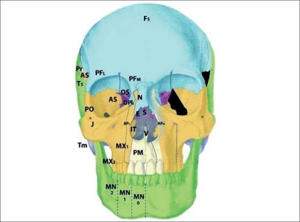 An anatomical diagram of a human skull from an anterior view, color-coded and labeled to demonstrate craniofacial developmental fields and Tessier cleft zones. The diagram highlights the frontal bone (Fs), orbital regions, maxilla (MX), mandible (MN), and nasal structures. Specifically, it illustrates the position of the alisphenoid (AS) or greater wing of the sphenoid in the lateral orbital wall and temporal fossa, bordered by the frontal (Fs), parietal (Pr), squamous temporal (Ts), and zygomatic (J, PO) bones. On the right side of the skull (viewer's right), a black-shaded area indicates a Tessier zone 9 cleft, characterized by a deficiency in the alisphenoid. This defect manifests visually as a significant gap in the lateral orbital wall and sphenofrontal region. Additional labels include the premaxilla (PM), vomer (V), and ethmoid (ES) regions, providing a comprehensive map of the osseous components involved in complex craniofacial clefting patterns.