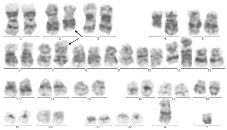 This diagnostic image shows a human G-banded karyotype (Giemsa staining) of a male (46,XY) in metaphase. The chromosomes are organized into 22 numbered pairs of autosomes and one pair of sex chromosomes (X and Y). The staining demonstrates characteristic light and dark banding patterns used for structural analysis. Specific arrows point to structural abnormalities on one homologue of chromosome 2 and chromosome 7, indicating a reciprocal translocation. Clinical context indicates these findings represent a clonal evolution in a pediatric patient with Pro-B-cell Acute Lymphoblastic Leukemia (pro-B-ALL). In addition to the visible 2;7 translocation, the karyotype is associated with a diagnostic t(4;11)(q21;q23) translocation, which is a common cytogenetic hallmark in high-risk infant leukemia involving the KMT2A (MLL) gene. This educational visual demonstrates how cytogenetic analysis identifies specific chromosomal rearrangements essential for hematologic malignancy diagnosis, risk stratification, and treatment planning.