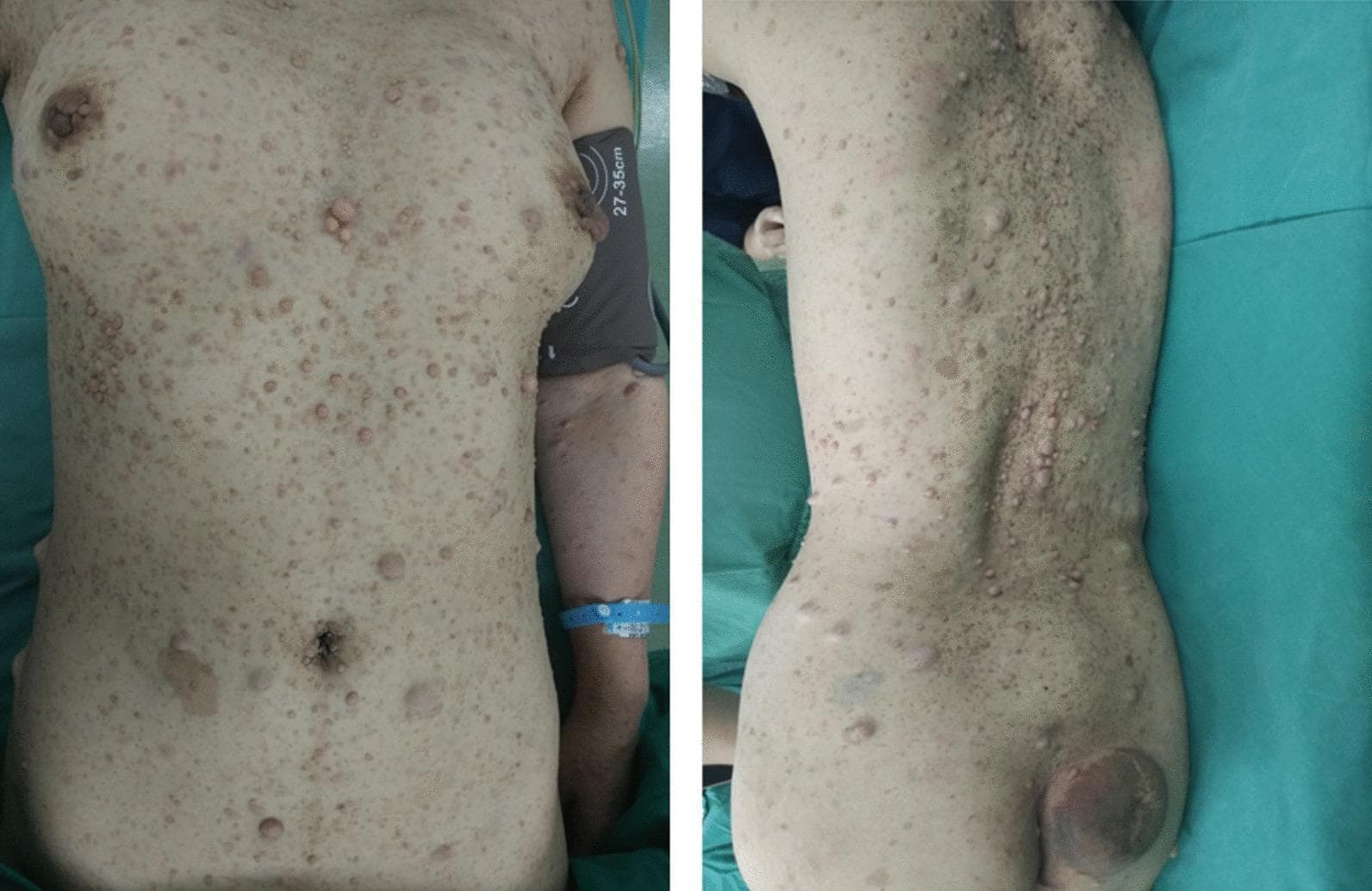 Two clinical photographs showing the anterior (left) and posterior (right) trunk of a 50-year-old female with extensive cutaneous neurofibromas, characteristic of Neurofibromatosis Type 1 (NF1). The anterior view demonstrates numerous skin-colored to light-brown, dome-shaped, and sessile nodules of varying sizes distributed across the chest and abdomen. The posterior view shows a higher density of lesions, particularly clustered along the paraspinal regions. Notably, a large, hyperpigmented, and prominent mass is visible on the right lower back/gluteal region, suggestive of a larger neurofibroma or potentially a plexiform variant. The lesions range from small papules to larger pedunculated masses. The presence of these multiple benign neurofibromas, combined with the clinical history of a posterior mediastinal malignant peripheral nerve sheath tumor (MPNST), illustrates the significant disease burden and potential for malignant transformation in patients with neurocutaneous syndromes.