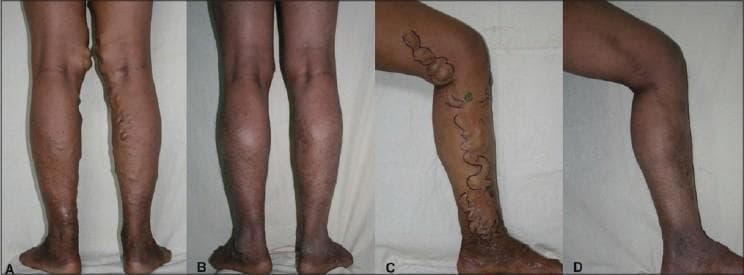 This composite clinical photograph (labeled A-D) illustrates the comparative outcomes of endovenous laser ablation for the treatment of varicose veins. Panels A and C display the preoperative status, showing significant vascular abnormalities of the lower extremities. Key features include prominent, dilated, and tortuous superficial veins (varicosities) primarily distributed along the posterior and medial aspects of the calves and thighs. These veins appear as raised, snake-like protrusions beneath the skin. In panel C, surgical markings delineate the planned treatment course along the Great Saphenous Vein distribution. Associated skin changes such as hyperpigmentation and darkening near the ankles are visible, suggesting chronic venous stasis and hemosiderin deposition. Panels B and D provide postoperative views following treatment with a 980 nm Diode laser. They demonstrate a marked reduction in venous distension, with the leg contours appearing significantly smoother and the pathological bulging resolving. The series highlights the efficacy of endovenous laser intervention in treating symptomatic venous insufficiency and its associated clinical manifestations.