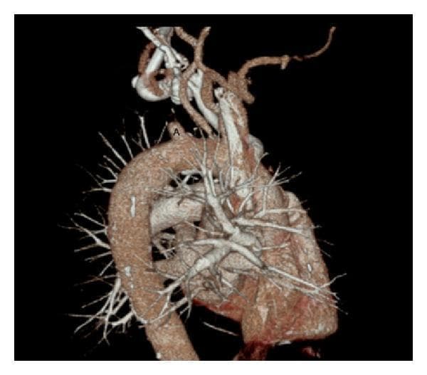 This diagnostic image is a 3D volume-rendered reconstruction of a computed tomography angiogram (CTA) of the chest, focusing on the thoracic aorta and its major branches. The aortic arch is clearly visualized, showing the origin of the great vessels. The brachiocephalic trunk and the left common carotid artery appear patent with normal contrast opacification. However, there is a significant vascular pathology at the origin of the left subclavian artery, labeled with 'A'. At this site, there is an abrupt termination of contrast enhancement, indicating a complete proximal occlusion of the left subclavian artery. The distal segment of the artery is not visualized via primary antegrade flow. The image also depicts the pulmonary arterial tree and smaller branching vessels. This finding is clinically significant for diagnosing subclavian steal syndrome or explaining significant inter-arm blood pressure discrepancies. The image serves as a clear educational example of arterial occlusion and the utility of 3D vascular reconstruction in identifying atherosclerotic or thrombotic vascular disease.