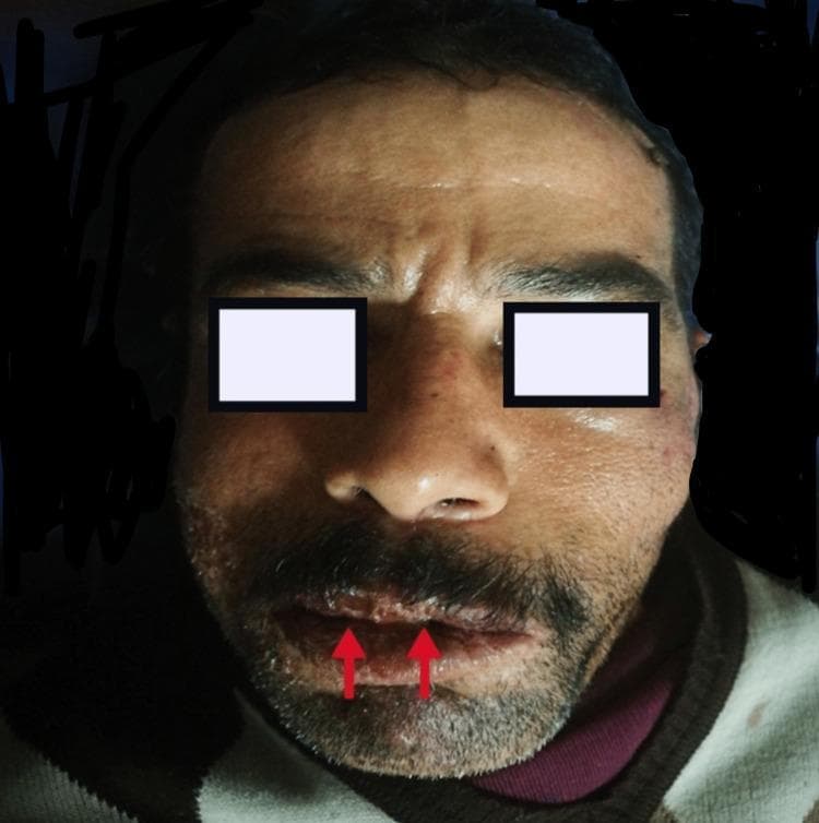 This clinical photograph shows a male patient exhibiting clear signs of left-sided peripheral facial nerve palsy (Bell's palsy) and concurrent erosive cheilitis. The facial asymmetry is characterized by the loss of forehead wrinkles on the left side, drooping of the left eyebrow, and a flattened left nasolabial fold. The mouth is noticeably deviated toward the unaffected right side. On the lips, the image highlights erosive cheilitis, with red arrows pointing to prominent vertical fissures and crusting on the vermilion border. This combination of symptoms—facial paralysis and lip inflammation—is clinically relevant for identifying conditions such as Melkersson-Rosenthal syndrome. The image serves as a high-quality educational resource for recognizing House-Brackmann Stage III facial nerve dysfunction and associated dermatological manifestations in a neurology or dermatology context.