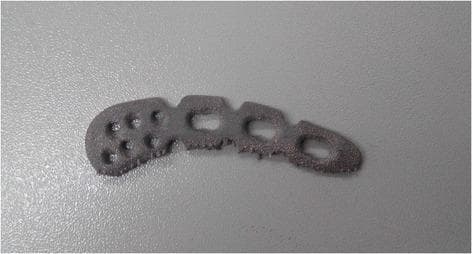 A clinical photograph of an orthopedic surgical implant: a Locking Compression Plate (LCP) designed for the superior anterior clavicle, manufactured using Electron Beam Melting (EBM) 3D printing technology from Ti-6Al-4V titanium alloy. The plate exhibits a contoured, elongated, and slightly curved morphology to match the anatomical shape of the clavicle. The proximal end (left) features a widened head with multiple small, circular locking screw holes. The distal shaft (right) contains three larger, oval-shaped dynamic compression apertures. The surface texture is notably granular and matte, characteristic of the additive manufacturing process, with visible rough edges and surface irregularities likely due to partially melted powder particles. This specimen demonstrates the application of patient-specific additive manufacturing in orthopedic trauma surgery to enhance implant strength and fit compared to traditional forged or cast plates.