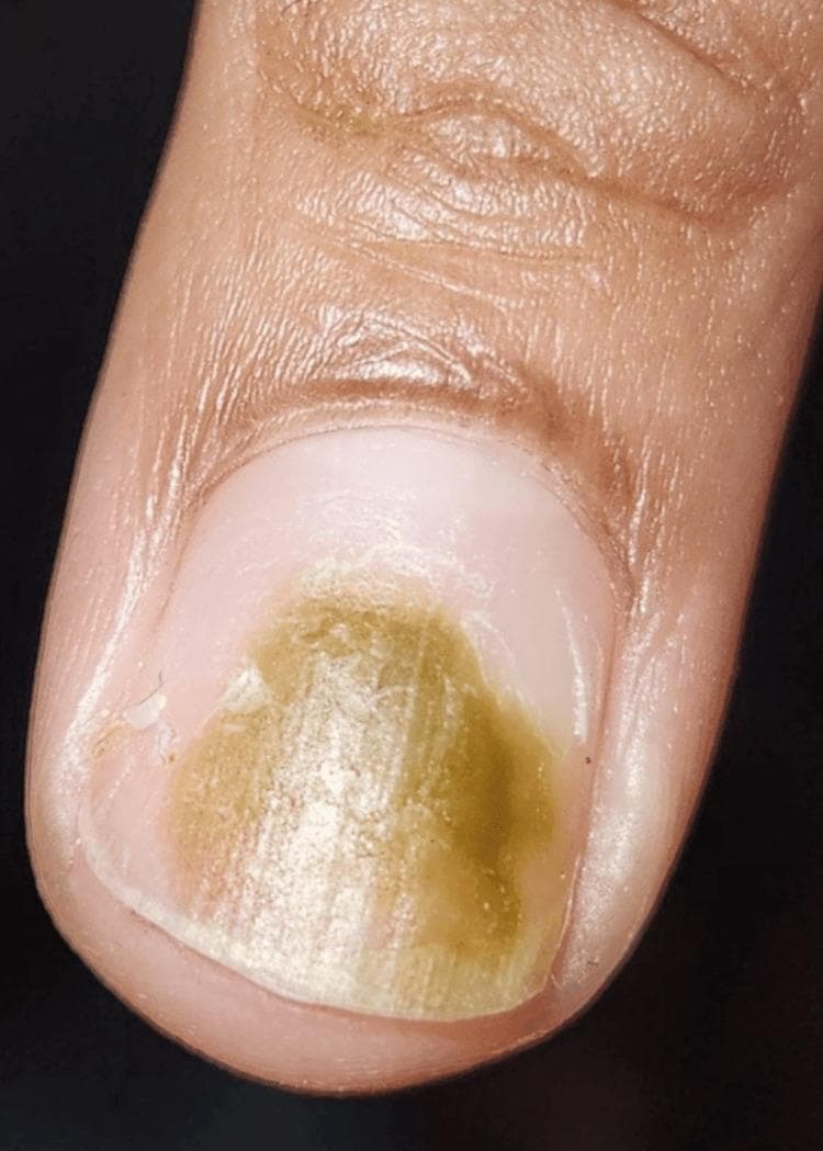 Clinical photograph of a human fingernail demonstrating Chloronychia (green nail syndrome). The image displays a clear, localized green-brown discoloration of the nail plate, primarily concentrated in the central and distal portions. The pigment distribution is non-uniform, featuring varying shades of olive green and yellowish-brown. The proximal nail fold, lunula, and surrounding paronychial skin appear healthy, without visible edema, erythema, or signs of acute paronychia. The nail plate surface remains relatively smooth and intact. This visual finding is classically associated with Pseudomonas aeruginosa infection, often occurring in moist environments or beneath artificial (acrylic) nails where subungual moisture is trapped. The image serves as a teaching tool for dermatological nail disorders and infectious disease identification.