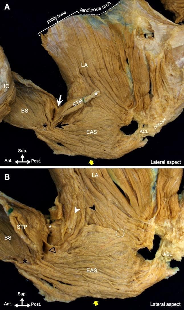 This clinical anatomical photograph displays a lateral cadaveric dissection of the human male pelvic floor muscles, divided into two panels (A and B). The imaging demonstrates the complex spatial relationships and intermuscular connections between the superficial and deep perineal layers. Panel A shows the superficial transverse perineal (STP) muscle originating near the lateral tendon (white star) and extending inferomedially to connect with the external anal sphincter (EAS, black arrow) and anteriorly with the bulbospongiosus (BS, white arrow). The BS and EAS are also linked (black asterisk). The levator ani (LA) is shown originating from the pubis bone and tendinous arch. Panel B, following lateral reflection of the STP, reveals the LA's bifurcation into anterior (white arrowhead) and posterior (black arrowhead) muscle bundles relative to the EAS. Key educational markers indicate the connection between the LA and BS (white asterisk), the blending point of the LA and EAS (white circle), and the connection between the STP and LA (black triangle). The anococcygeal ligament (ACL) is visible posteriorly, anchoring the EAS to the coccyx. This visual resource is intended for advanced medical education in surgical anatomy and pelvic floor functional pathology.