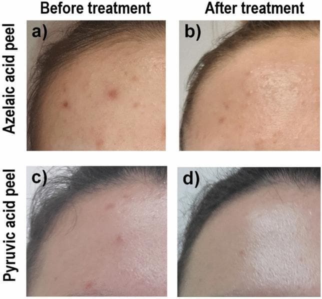 This clinical photograph comparison demonstrates the efficacy of chemical peels in treating acne vulgaris on the forehead. The image is divided into four quadrants (a-d) illustrating results from two different treatment groups: Azelaic Acid (AA) and Pyruvic Acid (PA). In the 'before' images (a and c), the forehead skin exhibits active acne lesions, including erythematous inflammatory papules, blackheads, and uneven texture associated with seborrhea. In the corresponding 'after' images (b and d), there is a visible reduction in lesion count and severity. Specifically, image (b) shows decreased erythema and flattening of papules following AA treatment. Image (d) displays significantly smoother skin texture and a reduction in inflammatory markers after PA treatment, with the skin appearing more reflective, suggesting improved surface regularity and potentially altered oiliness. This visual comparison serves as an educational tool for dermatological assessment using the Scale of Hellegren-Vincent Severity Symptoms (SHVSS) and highlights the role of organic acids in managing mild to moderate late acne symptoms in young adults.