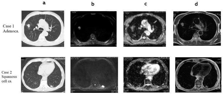 Multi-modal chest imaging comparison of two primary lung cancer types: Adenocarcinoma (Case 1) and Squamous Cell Carcinoma (Case 2). The 4x2 grid displays axial sections across four modalities: (a) Computed Tomography (CT), (b) Diffusion-Weighted Imaging (DWI), (c) Apparent Diffusion Coefficient (ADC) maps, and (d) T2-Weighted Imaging (T2WI). In Case 1, the adenocarcinoma presents as a focal nodule in the right lung field with hyperintensity on DWI and corresponding hypointensity on the ADC map (1.39 x 10^-3 mm^2/s), indicating restricted diffusion. In Case 2, the squamous cell carcinoma is located in the left posterior lung periphery, demonstrating stronger signal suppression on the ADC map (1.04 x 10^-3 mm^2/s) compared to Case 1. T2WI reveals heterogeneous internal architecture for the adenocarcinoma and a more homogeneous appearance for the squamous cell carcinoma. This comparative imaging set illustrates the diagnostic utility of combining structural (CT) and functional (DWI/ADC) MRI sequences to characterize pulmonary nodules and differentiate histological subtypes based on diffusion restriction and T2 contrast ratios.