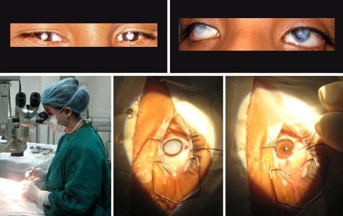 A multi-panel medical figure illustrating pediatric ophthalmological pathology and surgical intervention. The top row contains two clinical photographs of child eyes showing causes of treatable blindness: the left panel displays bilateral congenital cataracts, characterized by dense leukocoria (white pupillary reflex); the right panel depicts bilateral corneal opacities, presenting as diffuse clouding and scarring of the corneal stroma. The bottom row showcases stages of cataract surgery and intraocular lens (IOL) implantation. The bottom-left panel shows a surgeon utilizing an operating microscope. The bottom-middle panel provides an intraoperative close-up of a dilated pupil with a dense cataractous lens held by a speculum. The bottom-right panel displays the postoperative appearance after cataract extraction and successful implantation of an artificial IOL, restoring clear visual axes. This progression serves as a clinical example of surgical remediation for congenital vision impairment.