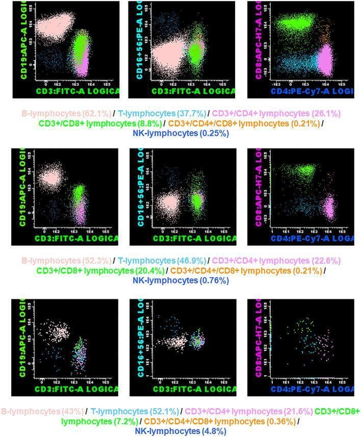 A series of multicolor flow cytometry scatter plots arranged in a 3x3 grid, used to characterize lymphocyte subpopulations in pediatric acute appendicitis. The rows represent three clinical states: the top row shows a control patient (absence of inflammation), the middle row represents Non-Complicated Acute Appendicitis (NCAA), and the bottom row represents Complicated Acute Appendicitis (CAA). Each column depicts specific immunophenotyping markers: (1) CD3:FITC-A vs. CD19:APC-A to differentiate T-lymphocytes and B-lymphocytes; (2) CD3:FITC-A vs. CD16+56:PE-A to identify Natural Killer (NK) cells; and (3) CD4:PE-Cy7-A vs. CD8:APC-H7-A to distinguish T-helper and cytotoxic T-cell subsets. The scatter plots use pseudocolor density gating to visualize cell populations. Accompanying numerical data underneath each row provides quantitative percentages for B-cells, T-cells, CD3+/CD4+, CD3+/CD8+, and NK-lymphocytes. This diagnostic image serves as a clinical immunology comparison for assessing inflammatory responses and immune profiling in surgical pathology.
