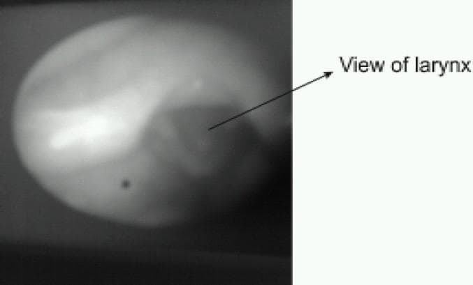 This diagnostic endoscopy image, captured via an LMA CTrach system, displays a grayscale view of the laryngeal structures as seen on an LCD monitor. The image features a circular field of view centered on the laryngeal inlet. Anatomically, the vocal cords are discernible as lighter linear contours positioned centrally, bordered by the darker aperture of the glottis. An arrow indicates the 'View of larynx,' highlighting the primary target area for endotracheal tube insertion. The visualization is achieved through fiberoptic channels integrated into the Laryngeal Mask Airway (LMA), designed to provide real-time guidance during tracheal intubation. The grayscale contrast helps identify the orientation of the epiglottis elevating bar relative to the glottic opening, which is essential for successful airway management and clinical training in anesthesiology and emergency medicine.