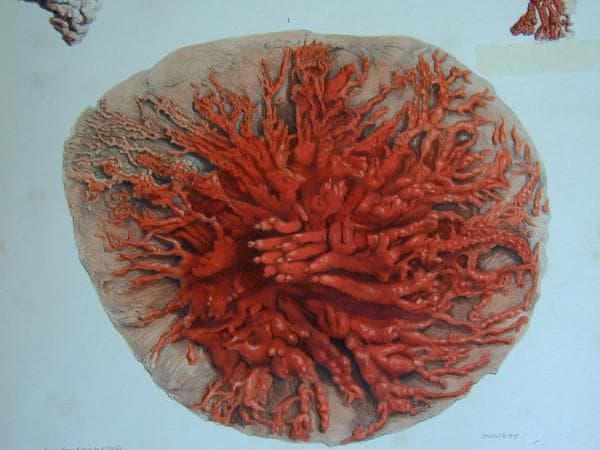 This historical anatomical illustration, derived from Sir Astley Cooper's 19th-century dissections, depicts the mammary ductal system of a lactating human breast. The image shows a wax-injected specimen where the lactiferous ducts are colored red to highlight their intricate architecture. The system exhibits a distinct radial symmetry, with major collecting ducts originating near the central nipple-areola complex and branching extensively as they move peripherally toward the glandular tissue. The ducts transition from thicker primary branches to increasingly fine, terminal arborizations, resembling a complex root or coral-like network. The illustration captures the high density of the ductal tree during lactation, demonstrating the interconnected pathways required for milk transport. This pedagogical material serves as a foundational reference for understanding breast anatomy, specifically the distribution of the lobulo-alveolar units and the patent ductal channels that accommodate milk ejection.