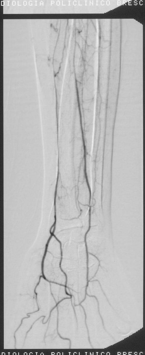 This diagnostic image is a digital subtraction angiogram (DSA) of the right forearm and wrist, captured following a thrombolysis procedure. The image depicts the arterial anatomy of the distal upper extremity, showing contrast opacification of the radial artery and its progression toward the hand. The radial artery exhibits continuous flow with a regular caliber, indicating a successful restoration of patency. In the wrist region, the image demonstrates clear vascularization with branching patterns and anastomoses forming the palmar arches. Smaller collateral vessels and tertiary branches are visible around the radio-carpal joint. The clinical significance of this imaging is to confirm the resolution of previous vasospasm or thromboembolic occlusion and to ensure adequate distal perfusion to the hand. This visual serves as an educational example of normal post-interventional vascular anatomy in the context of interventional radiology and vascular surgery.