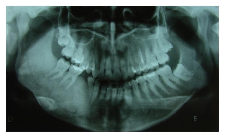 This diagnostic image is a panoramic dental radiograph (orthopantomogram) of a human mandible and maxilla. The primary finding is a large, poorly defined radiopaque lesion located in the right hemimandible. The lesion exhibits a classic 'ground glass' appearance, characterized by a fine, granular, and uniform increase in bone density that blends into the surrounding healthy bone. This finding is highly suggestive of fibrous dysplasia, specifically the monostotic form given the localized presentation. The lesion involves the mandibular body and ramus, causing expansion and altering the normal trabecular pattern. Dental examination reveals the absence of teeth 4.5 and 4.8, consistent with historical surgical extraction. The contralateral (left) mandible appears normal in bone density and structure. This radiograph serves as an educational example of fibro-osseous lesions of the jaws, emphasizing the importance of recognizing specific radiographic textures like 'ground glass' for differential diagnosis between fibrous dysplasia, ossifying fibroma, and chronic osteomyelitis.