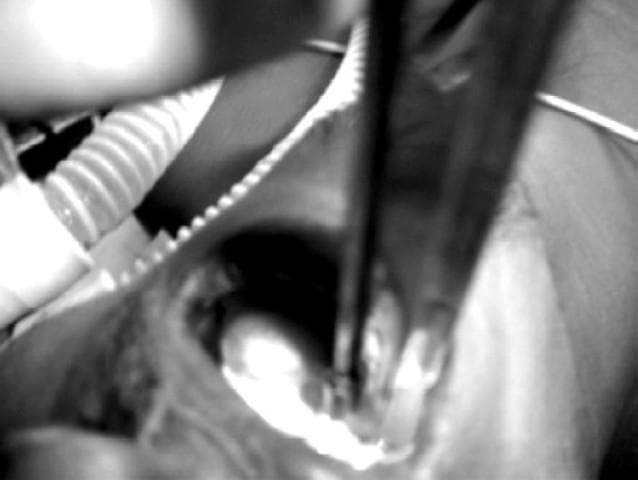 This clinical photograph captures a direct laryngoscopy performed using a right molar approach with a Miller no. 3 straight blade. The image demonstrates the specialized airway management technique required for a patient with a pedicled tongue flap, which is visible in the oral cavity. The straight Miller blade is positioned to lift the epiglottis directly, facilitating a clear view of the glottic opening for endotracheal intubation. The right molar approach is utilized to bypass the central tongue flap, minimizing the risk of traumatic injury to the surgical site. Visible adjuncts include a corrugated anesthesia breathing circuit and a fine suction or catheter tube in the foreground. This visual illustrates a modification of standard intubation protocols in the context of reconstructive maxillofacial surgery, specifically for a patient with a prior palatal fistula repair. The image serves as an educational resource for anesthesiology and oral-maxillofacial surgery, focusing on difficult airway management and the clinical utility of straight laryngoscope blades in restricted oropharyngeal spaces.