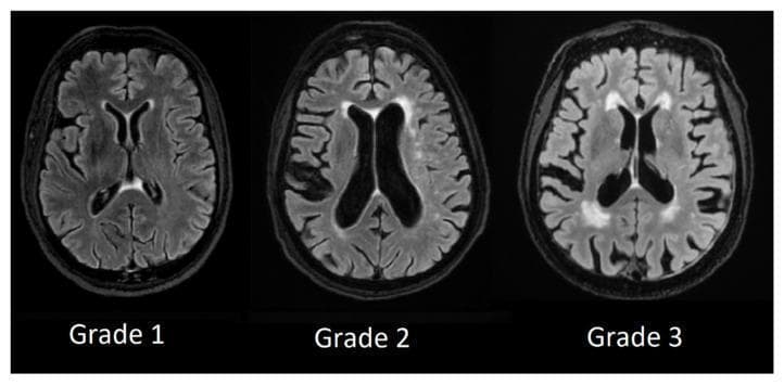 Comparison of axial MRI brain scans (T2-weighted FLAIR sequence) demonstrating the Fazekas scale for periventricular white matter hyperintensities (PVWMH). The image illustrates three levels of disease progression: Grade 1 displays mild, thin hyperintensities limited to the 'caps' of the anterior and posterior ventricular horns. Grade 2 shows a more pronounced 'smooth halo' of hyperintensity surrounding the lateral ventricles. Grade 3 depicts severe, irregular, and confluent hyperintensities extending significantly from the ventricles into the deep white matter. These visual findings are critical diagnostic markers for cerebral small vessel disease, often associated with vascular dementia and cognitive decline. The scans provide a clear visual reference for neuroradiological grading and the assessment of white matter integrity.