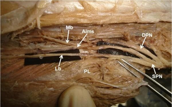 Anatomical dissection photograph of a human left lower limb, focusing on the proximal calf region to demonstrate a high division of the superficial peroneal nerve (SPN). The SPN is shown bifurcating early into its two terminal branches: the medial branch (Mb) and the lateral branch (Lb). The medial branch runs superiorly and is seen piercing the anterior intermuscular septum (Aims). The lateral branch descends inferiorly, running superficial to the peroneus longus (PL) muscle. To facilitate visibility, black background strips have been placed behind the nerve branches. The deep peroneal nerve (DPN) is also visible, situated superior to the SPN trunk. This image serves as a clinical anatomical reference for nerve variations in the lateral compartment of the leg, highlighting the relationship between neurovascular structures and the crural fascia, which is significant for surgical decompression and regional anesthesia.