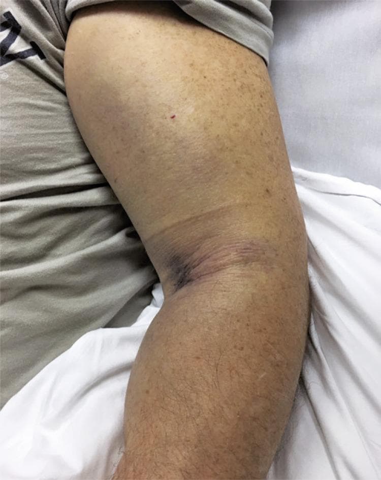 Clinical photograph of a patient's upper limb, demonstrating significant pathology indicative of acute traumatic injury and potential compartment syndrome. The image shows massive edema and soft tissue swelling extending from the mid-humerus to the forearm. A prominent area of ecchymosis and deep purple discoloration is localized to the antecubital fossa and medial elbow region, suggesting a significant underlying hematoma. The skin in the affected area appears taut and shiny due to increased interstitial pressure, with exaggerated skin folds at the elbow crease. Additional features include scattered lentigines and a small puncture or petechial spot on the lateral upper arm. This visual serves as a critical clinical marker for musculoskeletal trauma involving tendon rupture or vascular injury, where intense swelling and pressure sensation necessitate urgent surgical evaluation to prevent neurovascular compromise. The photograph highlights the clinical presentation of pre-operative compartment syndrome risk in the upper extremity.