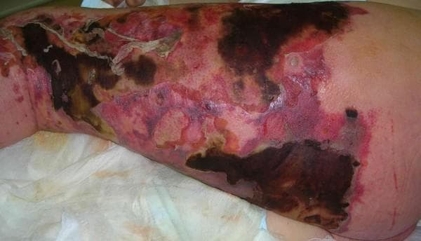 This clinical photograph displays a 43-year-old male's left lower extremity, demonstrating severe soft tissue infection consistent with necrotizing fasciitis. The image shows extensive, confluent areas of skin necrosis characterized by dark brown and black eschar formation, particularly on the lateral thigh and spreading toward the buttock and perineum. Surrounding these necrotic regions is marked, diffuse erythema and violaceous discoloration, indicating severe underlying inflammation. There is evidence of skin sloughing and epidermal detachment, with areas of pale, devitalized tissue exposed. The margins of the infection appear sharply demarcated in some areas while showing a spreading inflammatory border in others. Clinical signs of edema and hemorrhagic extravasation are visible throughout the affected limb. This image serves as a significant visual educational tool for recognizing the rapid progression of fulminant skin and soft tissue infections and the life-threatening necessity of surgical debridement.