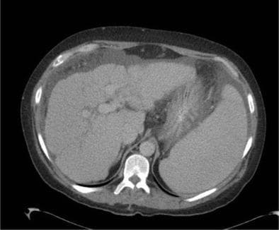 This axial contrast-enhanced CT scan of the abdomen in the portal venous phase illustrates hallmark imaging features of advanced cirrhosis and portal hypertension. The liver demonstrates a markedly irregular, nodular surface contour and a heterogeneous parenchymal appearance. A significant volume of low-attenuation fluid is visible within the peritoneal cavity, representing ascites, which serves to clearly outline the nodular hepatic capsule. On the contralateral side, there is pronounced splenomegaly, a common consequence of increased pressure within the portal venous system. The presence of these combined findings—cirrhotic liver morphology, ascites, and splenomegaly—is highly characteristic of chronic liver disease with secondary portal hypertension. The image serves as a clinical example of how fluid accumulation can enhance the visual assessment of organ surface characteristics in diagnostic radiology.