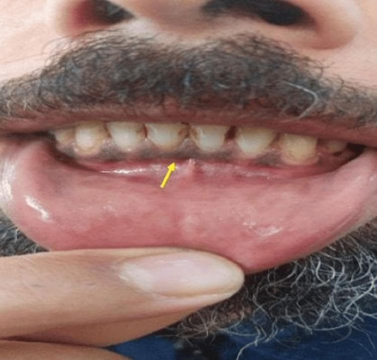 This clinical photograph displays intraoral imaging of a male patient’s lower oral cavity. The focal point, highlighted by a yellow arrow, is a distinct bluish-purple pigmented line along the marginal gingiva of the mandibular teeth. This finding is characteristic of a 'Burtonian line' (or Burton line), a clinical sign associated with chronic lead poisoning (plumbism). The pigmentation results from the reaction between circulating lead and sulfur-producing bacteria in the oral plaque, forming lead sulfide precipitates. The surrounding gingival tissues appear otherwise normal in texture, though some mild dental staining is visible at the cervical margins of the teeth. This image serves as a classic diagnostic aid in toxicology and occupational medicine, illustrating a characteristic physical manifestation of heavy metal toxicity in patients presenting with systemic symptoms like fatigue, abdominal pain, and metallic taste.