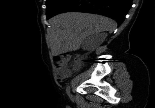 This diagnostic image is a sagittal view of an abdominal-pelvic CT scan (TDM). It demonstrates key radiological findings indicative of acute retrocecal appendicitis. A prominent feature is the distended and thickened vermiform appendix, indicated by a horizontal black arrow. The appendix measures approximately 12 mm in diameter, exceeding the standard threshold for inflammation. It is positioned posteriorly to the cecum, confirming a retrocecal anatomical variant. Furthermore, there is a visible loss of the normal low-density appearance of the surrounding mesenteric fat, characterized as periappendiceal fat stranding or infiltration. This increased attenuation in the fat neighboring the thickened appendix is a secondary sign of localized inflammatory response. The image serves as a clinical example for medical students and radiology residents to identify primary and secondary signs of appendicitis in unconventional anatomical positions using cross-sectional imaging.