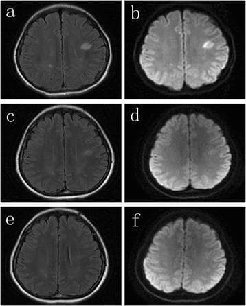 This diagnostic imaging panel consists of six axial brain MRI scans (a-f) illustrating the progression and resolution of lesions in a patient with anti-NMDA receptor encephalitis. The images are organized into three timepoints, each featuring Fluid-Attenuated Inversion Recovery (FLAIR) and Diffusion-Weighted Imaging (DWI) sequences. (a, b) Initial scans show prominent, focal hyperintense lesions in the bilateral subcortical white matter, most notably in the left hemisphere. (c, d) One month following plasma exchange, there is significant interval reduction in the size and signal intensity of these lesions, representing partial resolution. (e, f) At the two-month follow-up, the final FLAIR and DWI images demonstrate complete resolution of the previous abnormalities, with the subcortical white matter appearing normal. The series highlights the neuroimaging manifestations of autoimmune encephalitis and the typical radiologic response to therapeutic intervention.