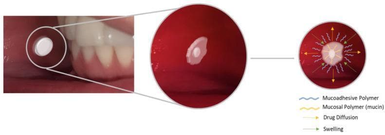 This educational graphic illustrates the pharmacokinetics and physical behavior of a mucoadhesive buccal tablet within the oral cavity. The image is divided into three sequential panels. The first panel shows a clinical photograph of a white, disc-shaped tablet placed against the buccal mucosa near the lower teeth. The second panel provides a magnified view of the tablet beginning to hydrate and swell, losing its distinct circular edges as it adheres to the mucosal tissue. The third panel is a schematic diagram detailing the molecular mechanism of adhesion and drug release. Key components identified in the legend include mucoadhesive polymers (blue wavy lines) and mucosal polymers/mucin (yellow wavy lines) interpenetrating at the interface. Green arrows indicate the physical swelling of the polymer matrix, while yellow radial arrows represent drug diffusion from the tablet core through the swollen layer and into the systemic circulation or local tissue. The illustration highlights the importance of polymer hydration and chain entanglement in transmucosal drug delivery.