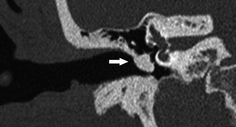 This diagnostic image is a high-resolution computerized tomography (CT) scan of the right temporal bone in a coronal view, specifically focused on the middle ear anatomy. The scan clearly depicts the auditory ossicles, including the handle of the malleus, the long process of the incus, and the head of the stapes. A significant finding is highlighted by a white arrow, pointing to a soft-tissue density opacification within the tympanic cavity. This abnormal density is shown enveloping the ossicular chain, particularly around the malleus and incus, replacing the normal air-filled space of the middle ear. The surrounding bony structures, including the external acoustic canal, the tegmen tympani, and elements of the inner ear (such as the cochlea and vestibular system), are visible for anatomical orientation. This image serves as an educational tool for identifying middle ear pathology, such as cholesteatoma, tympanosclerosis, or chronic otitis media, by demonstrating how soft-tissue masses can obscure normal air spaces and interact with the ossicular chain.