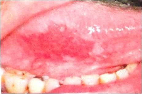 This clinical photograph displays a high-magnification view of the oral cavity, specifically the lateral border of the tongue. The primary finding is a well-demarcated, bright red, erythematous patch known as erythroplakia. The lesion exhibits a soft, velvety texture and lacks the keratinized surface characteristic of leukoplakia. This atrophic appearance results from epithelial thinning, which makes the underlying microvasculature more visible. Adjacent to the tongue, mandibular teeth with visible dental restorations are present. From a clinical perspective, erythroplakia is a significant precancerous condition, as it is histologically associated with severe epithelial dysplasia, carcinoma in situ, or invasive squamous cell carcinoma in approximately 90% of cases. The image serves as a key diagnostic example for oral pathology and oncology, emphasizing the importance of identifying non-ulcerated red lesions that cannot be attributed to other inflammatory or traumatic causes.